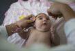 Γεννήθηκε το πρώτο μωρό στην Ευρώπη με μικροκεφαλία από τον ιό Ζίκα